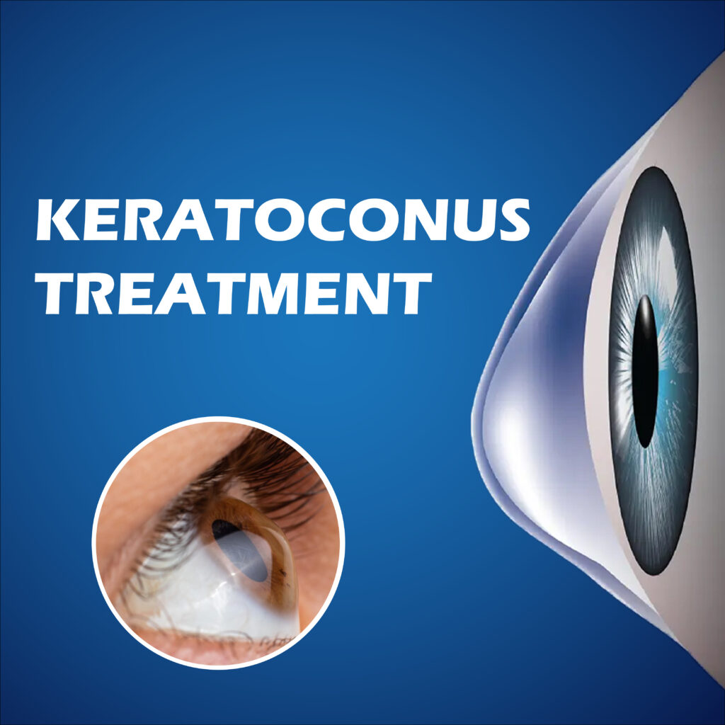 Keratoconus Contact Lens