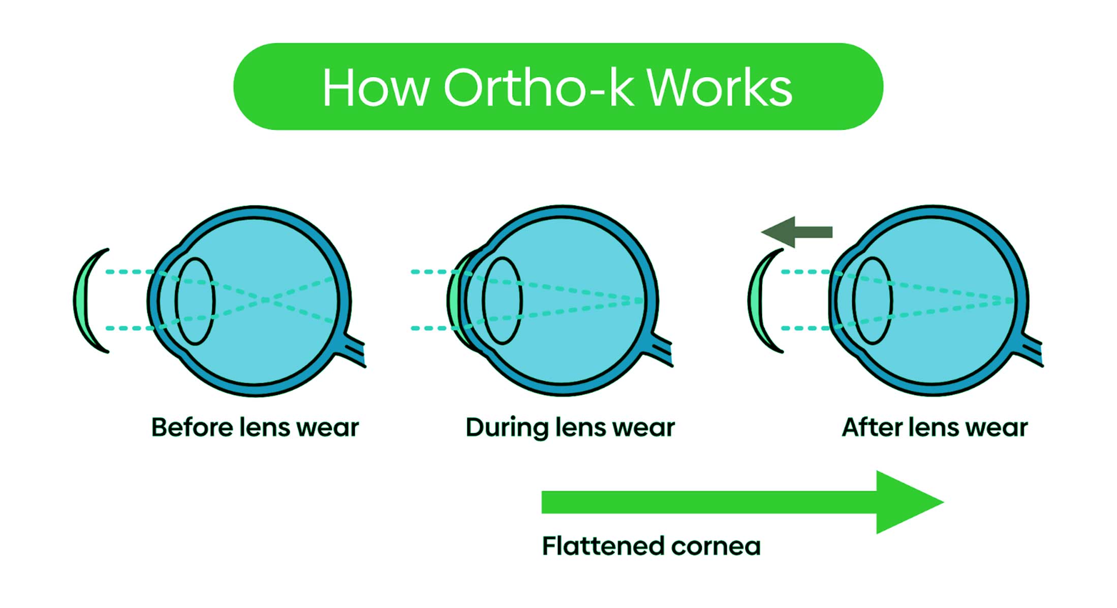 Ortho-K Lenses in Dubai